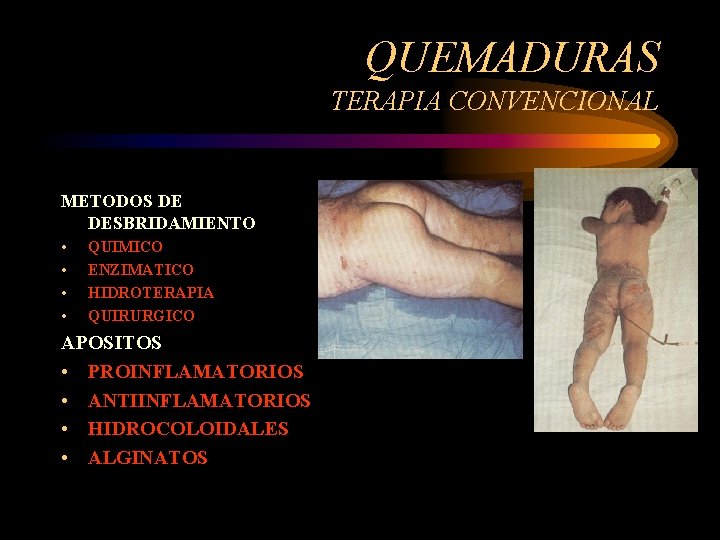 QUEMADURAS TERAPIA CONVENCIONAL METODOS DE DESBRIDAMIENTO • • QUIMICO ENZIMATICO HIDROTERAPIA QUIRURGICO APOSITOS •