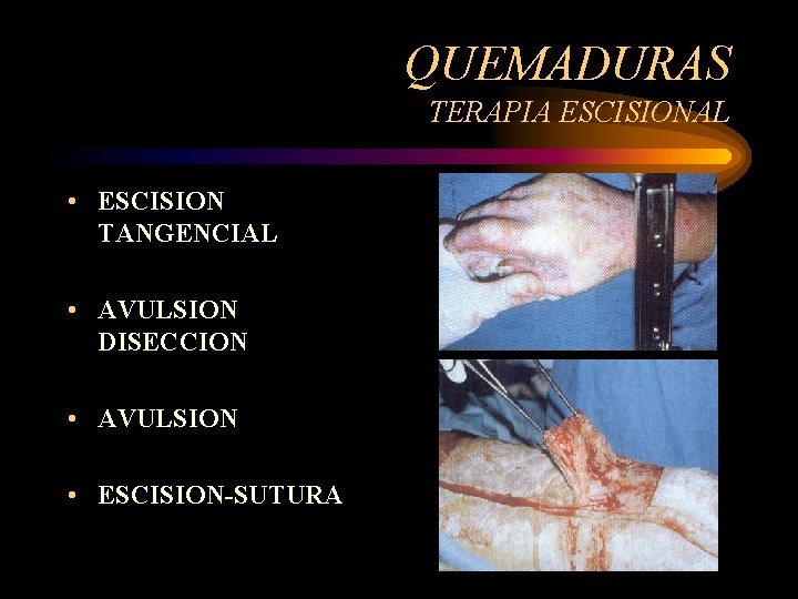 QUEMADURAS TERAPIA ESCISIONAL • ESCISION TANGENCIAL • AVULSION DISECCION • AVULSION • ESCISION-SUTURA 