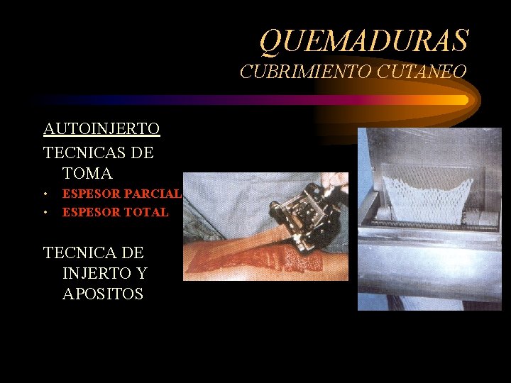 QUEMADURAS CUBRIMIENTO CUTANEO AUTOINJERTO TECNICAS DE TOMA • • ESPESOR PARCIAL ESPESOR TOTAL TECNICA
