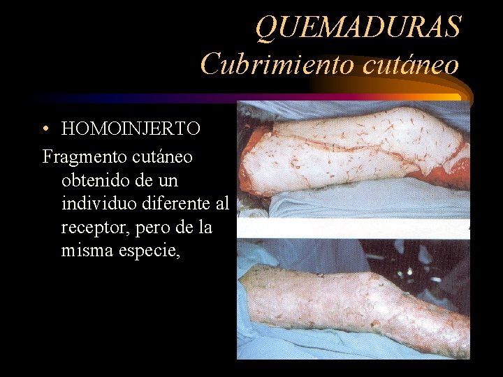 QUEMADURAS Cubrimiento cutáneo • HOMOINJERTO Fragmento cutáneo obtenido de un individuo diferente al receptor,