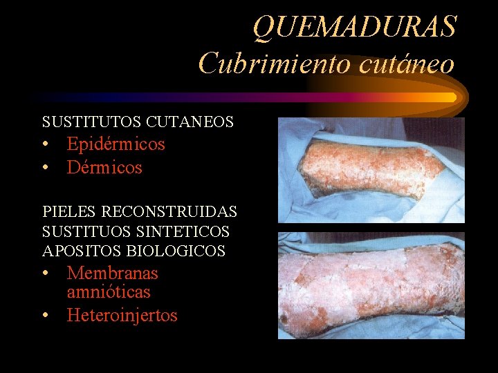 QUEMADURAS Cubrimiento cutáneo SUSTITUTOS CUTANEOS • Epidérmicos • Dérmicos PIELES RECONSTRUIDAS SUSTITUOS SINTETICOS APOSITOS