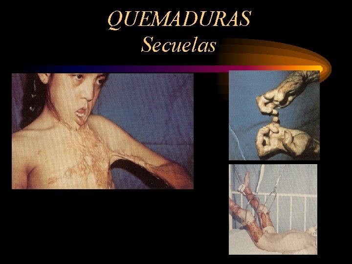 QUEMADURAS Secuelas 