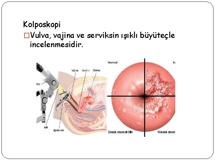 Kolposkopi �Vulva, vajina ve serviksin ışıklı büyüteçle incelenmesidir. 