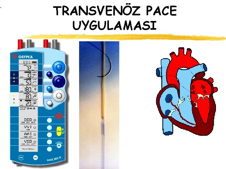 TRANSVENÖZ PACE UYGULAMASI 