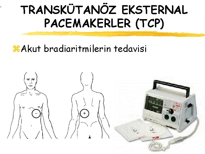 TRANSKÜTANÖZ EKSTERNAL PACEMAKERLER (TCP) z. Akut bradiaritmilerin tedavisi 
