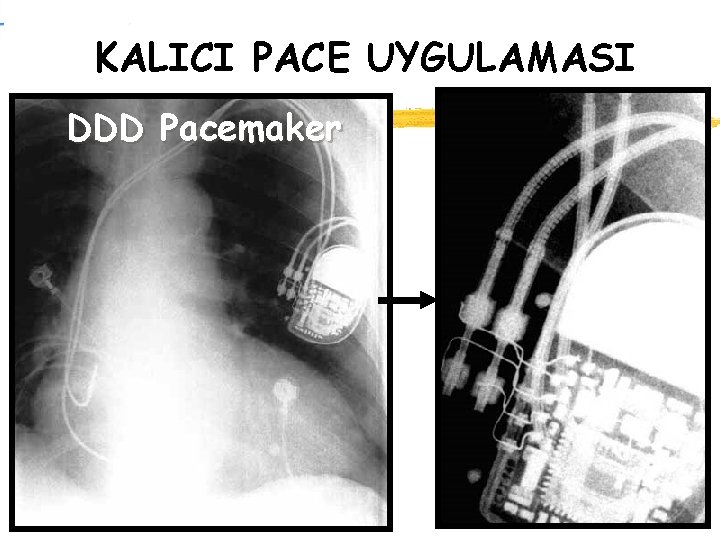 KALICI PACE UYGULAMASI DDD Pacemaker 