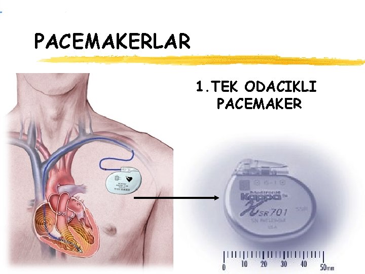 PACEMAKERLAR 1. TEK ODACIKLI PACEMAKER 