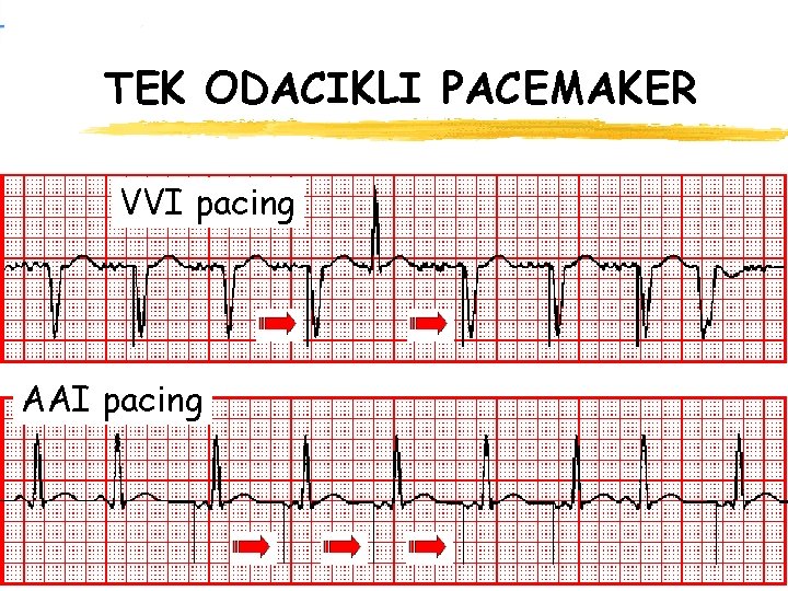 TEK ODACIKLI PACEMAKER VVI pacing AAI pacing 