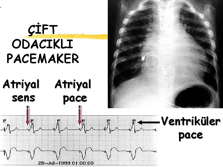 ÇİFT ODACIKLI PACEMAKER Atriyal sens Atriyal pace Ventriküler pace 