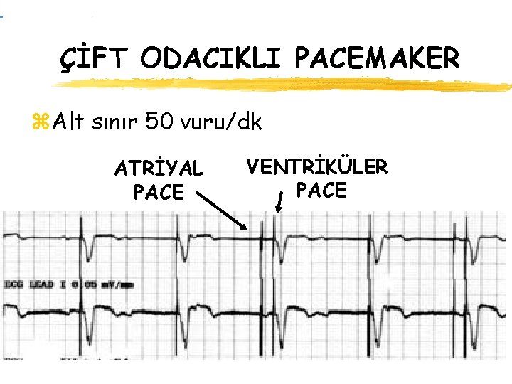 ÇİFT ODACIKLI PACEMAKER z. Alt sınır 50 vuru/dk ATRİYAL PACE VENTRİKÜLER PACE 