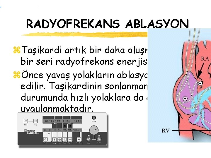 RADYOFREKANS ABLASYON z. Taşikardi artık bir daha oluşmayınca dek bir seri radyofrekans enerjisi uygulanır.