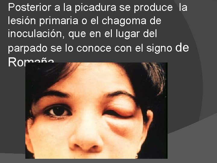 Posterior a la picadura se produce la lesión primaria o el chagoma de inoculación,