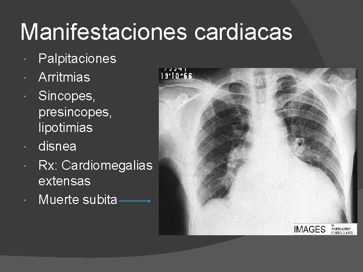 Manifestaciones cardiacas Palpitaciones Arritmias Sincopes, presincopes, lipotimias disnea Rx: Cardiomegalias extensas Muerte subita 