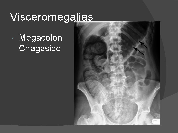 Visceromegalias Megacolon Chagásico 