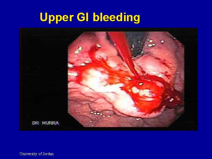 Upper GI bleeding University of Jordan 