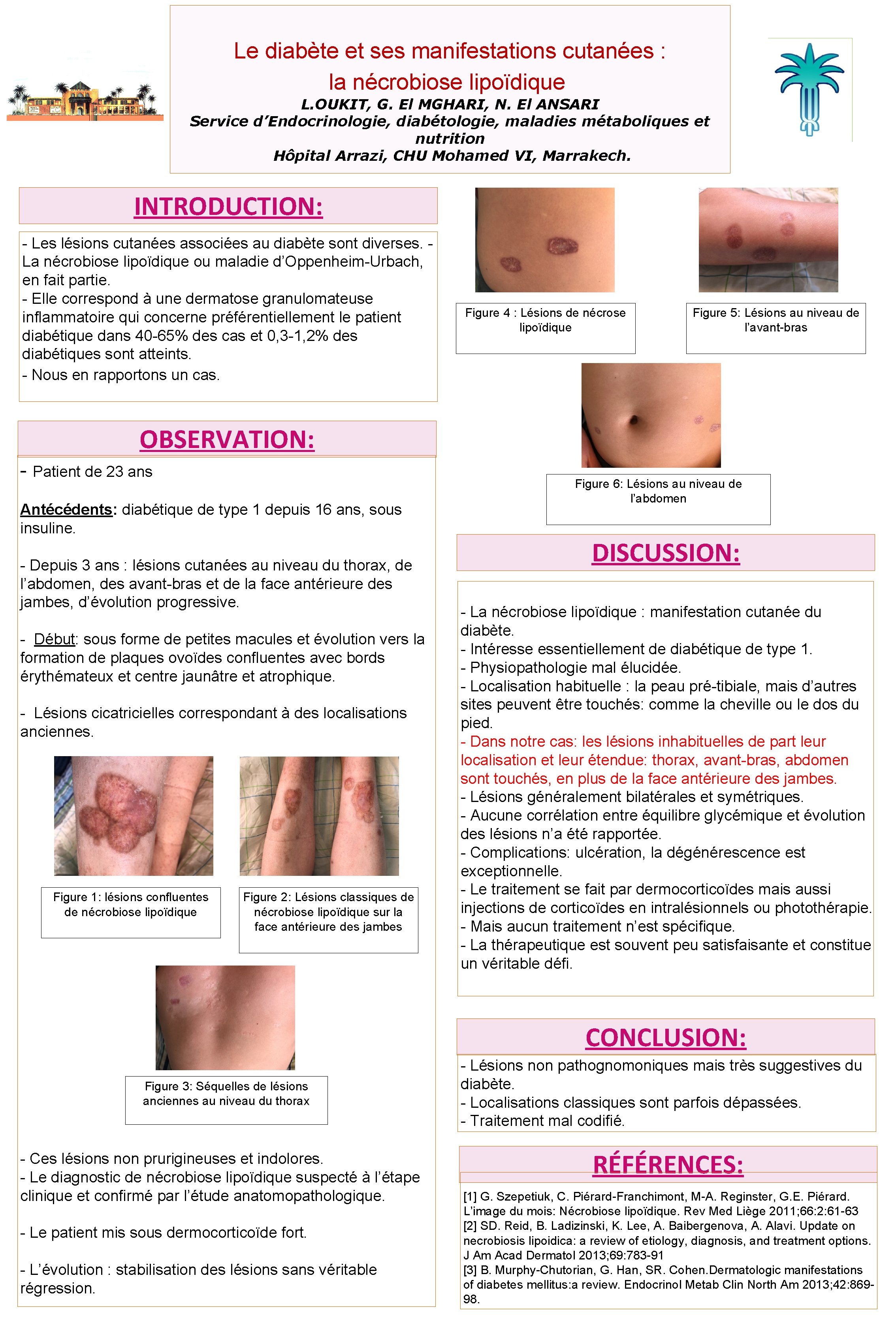 Le diabète et ses manifestations cutanées : la nécrobiose lipoïdique L. OUKIT, G. El