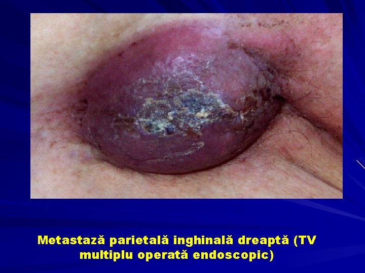 Metastază parietală inghinală dreaptă (TV multiplu operată endoscopic) 