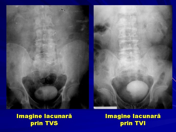 Imagine lacunară prin TVS Imagine lacunară prin TVI 