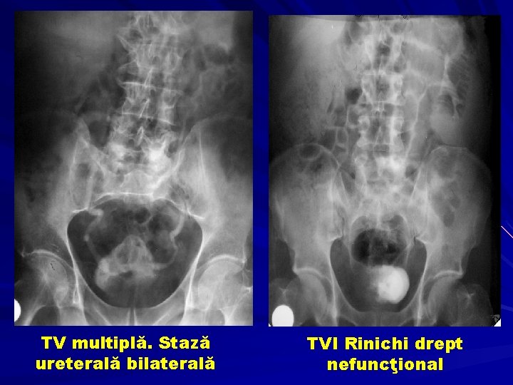 TV multiplă. Stază ureterală bilaterală TVI Rinichi drept nefuncţional 