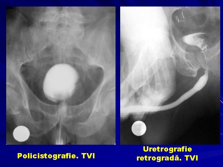Policistografie. TVI Uretrografie retrogradă. TVI 