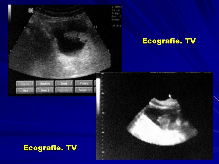 Ecografie. TV 