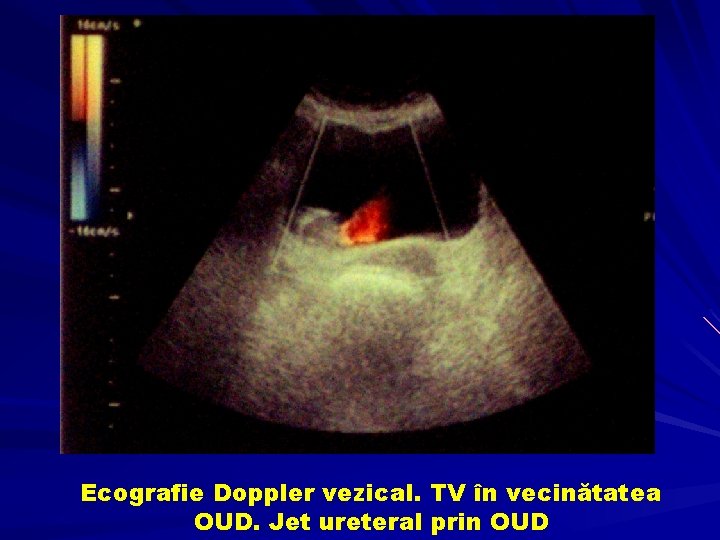 Ecografie Doppler vezical. TV în vecinătatea OUD. Jet ureteral prin OUD 