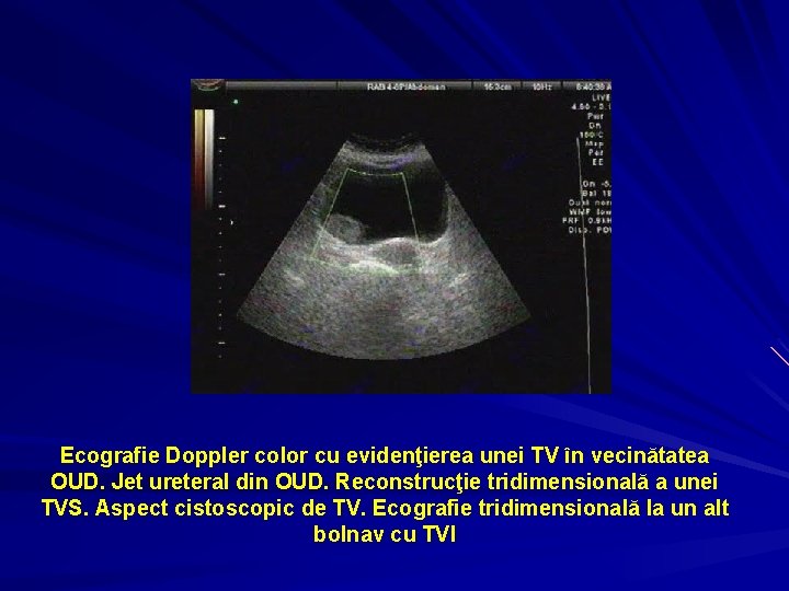 Ecografie Doppler color cu evidenţierea unei TV în vecinătatea OUD. Jet ureteral din OUD.