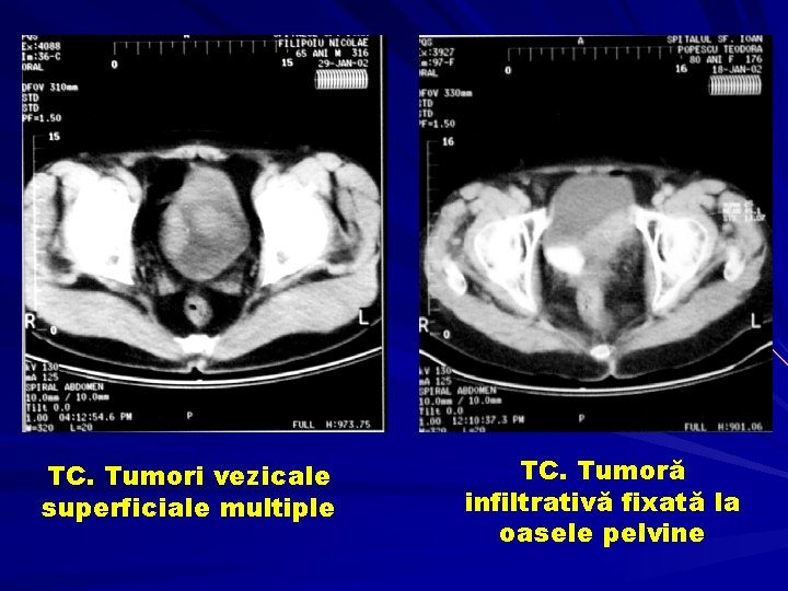 TC. Tumori vezicale superficiale multiple TC. Tumoră infiltrativă fixată la oasele pelvine 
