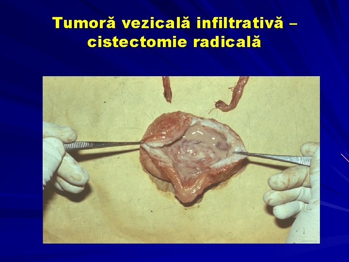 Tumoră vezicală infiltrativă – cistectomie radicală 