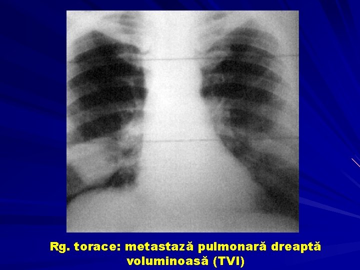Rg. torace: metastază pulmonară dreaptă voluminoasă (TVI) 