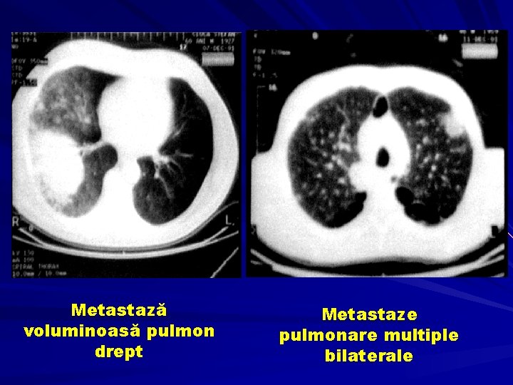 Metastază voluminoasă pulmon drept Metastaze pulmonare multiple bilaterale 