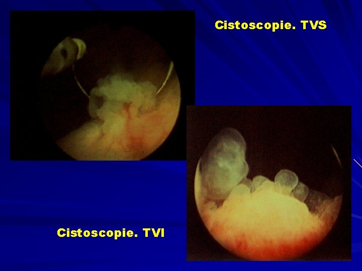 Cistoscopie. TVS Cistoscopie. TVI 