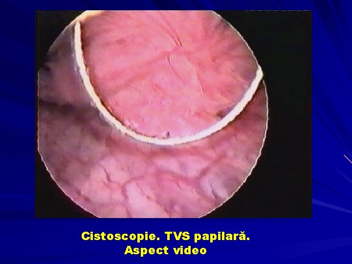 Cistoscopie. TVS papilară. Aspect video 