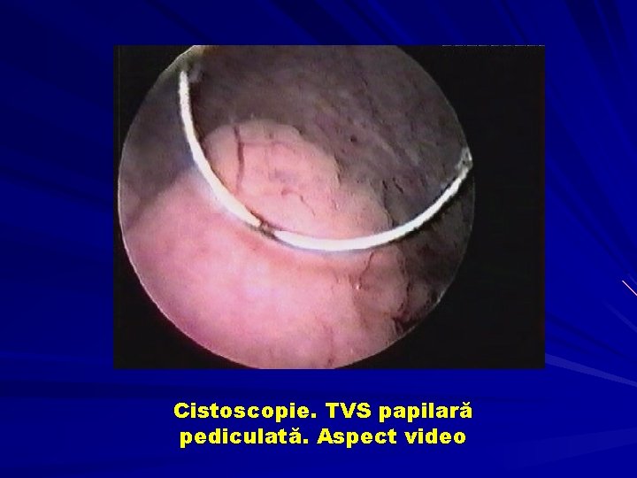 Cistoscopie. TVS papilară pediculată. Aspect video 