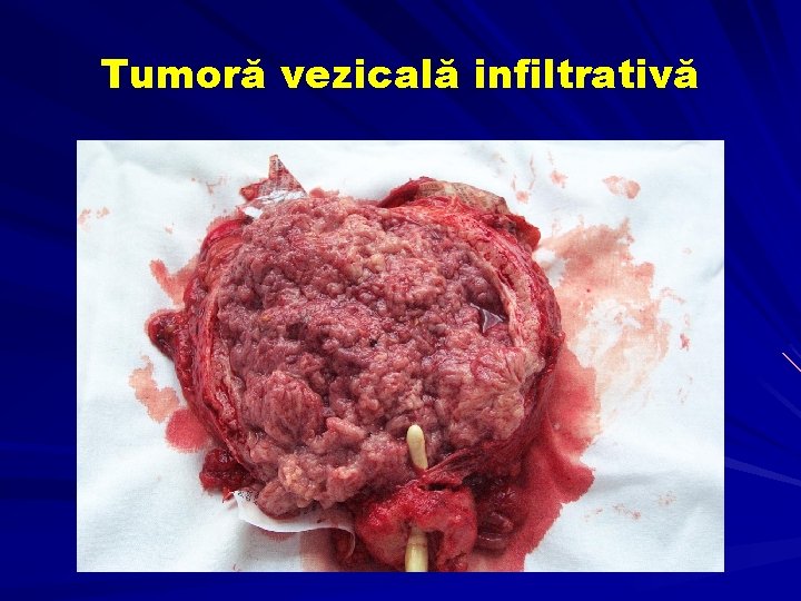 Tumoră vezicală infiltrativă 