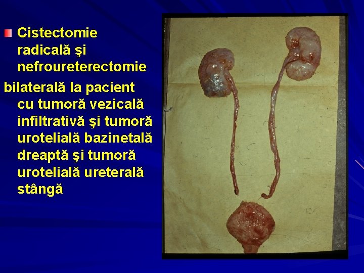 Cistectomie radicală şi nefroureterectomie bilaterală la pacient cu tumoră vezicală infiltrativă şi tumoră urotelială