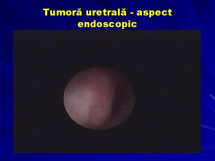 Tumoră uretrală - aspect endoscopic 