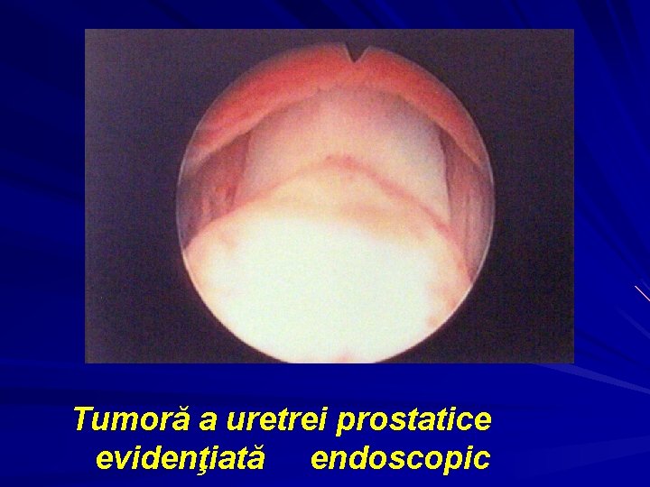 Tumoră a uretrei prostatice evidenţiată endoscopic 