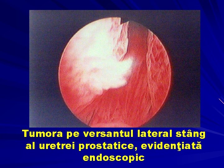 Tumora pe versantul lateral stâng al uretrei prostatice, evidenţiată endoscopic 