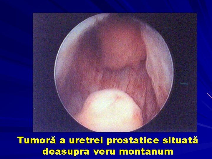 Tumoră a uretrei prostatice situată deasupra veru montanum 