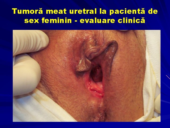 Tumoră meat uretral la pacientă de sex feminin - evaluare clinică 