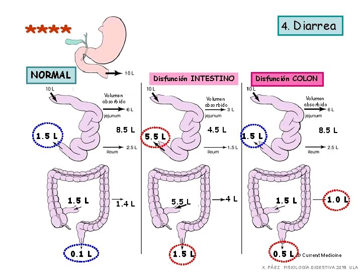 4. Diarrea **** NORMAL Disfunción INTESTINO Volumen absorbido 8. 5 L 1. 5 L