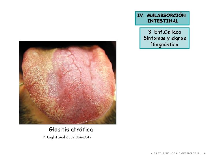 IV. MALABSORCIÓN INTESTINAL 3. Enf. Celíaca Síntomas y signos Diagnóstico Glositis atrófica N Engl