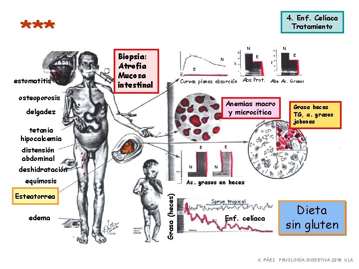 *** estomatitis 4. Enf. Celíaca Tratamiento N Biopsia: Atrofia Mucosa intestinal N E Curvas