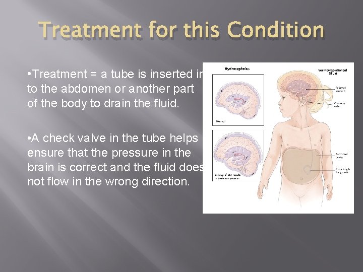 Treatment for this Condition • Treatment = a tube is inserted in to the