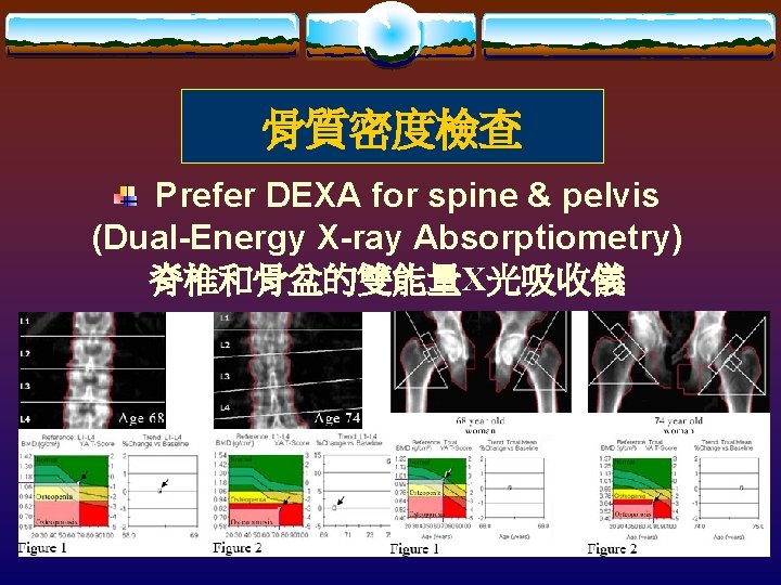 骨質密度檢查 Prefer DEXA for spine & pelvis (Dual-Energy X-ray Absorptiometry) 脊椎和骨盆的雙能量X光吸收儀 