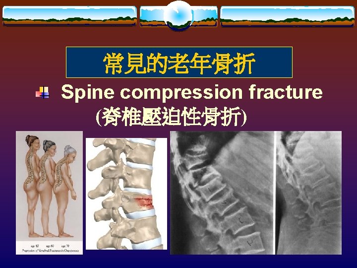 常見的老年骨折 Spine compression fracture (脊椎壓迫性骨折) 