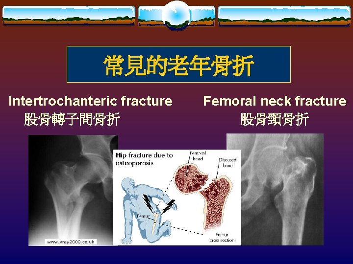 常見的老年骨折 Intertrochanteric fracture 股骨轉子間骨折 Femoral neck fracture 股骨頸骨折 