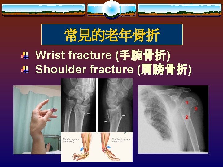 常見的老年骨折 Wrist fracture (手腕骨折) Shoulder fracture (肩膀骨折) 