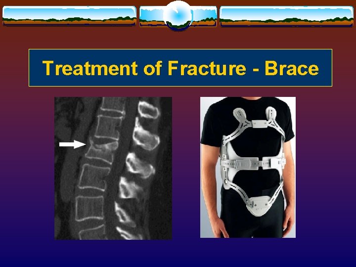 Treatment of Fracture - Brace 